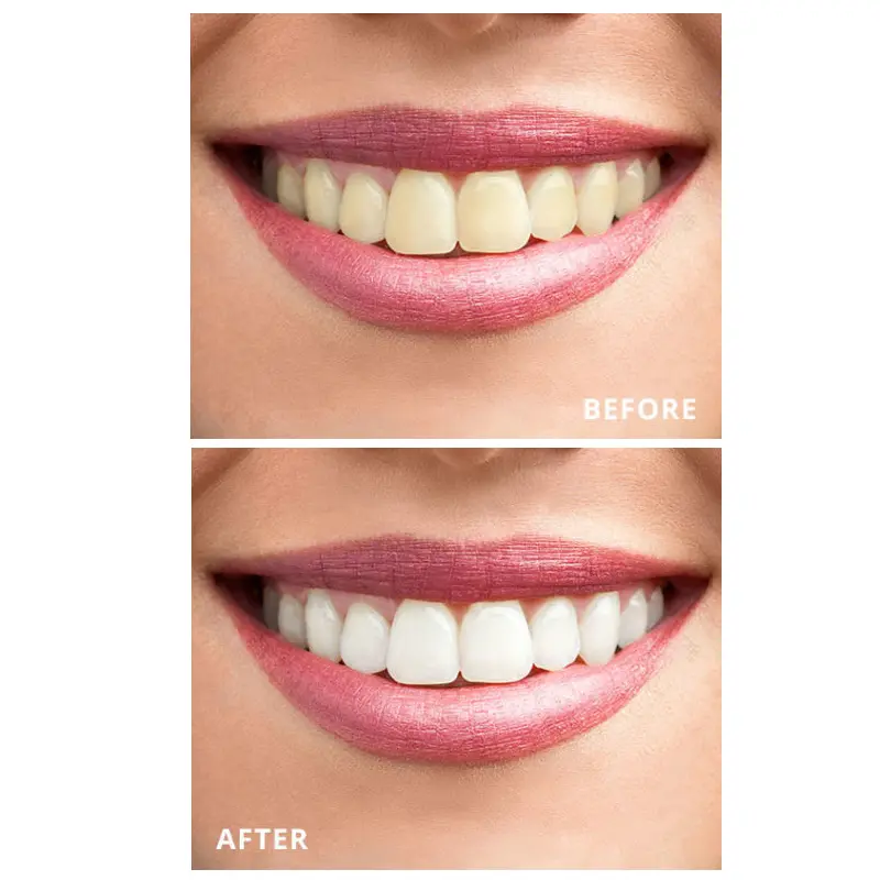 Teeth Whitening Mouth Tray Dual Soft Tray GW-MT03 004tsn