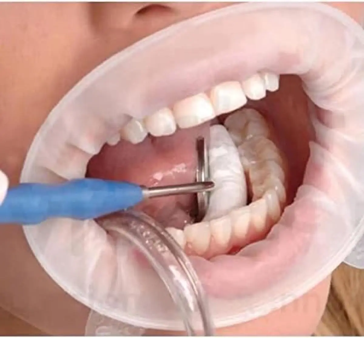 Teeth Whitening and Dental Cheek Retractor, Disposable O Shape Mouth Opener Gag, Sterilized Hygienic Dental Lip Protector (14)3r5