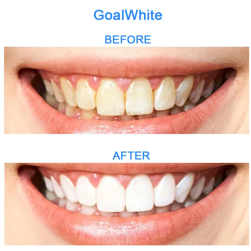 GoalWhite teeth whitening mouth tray MT11 0037n4